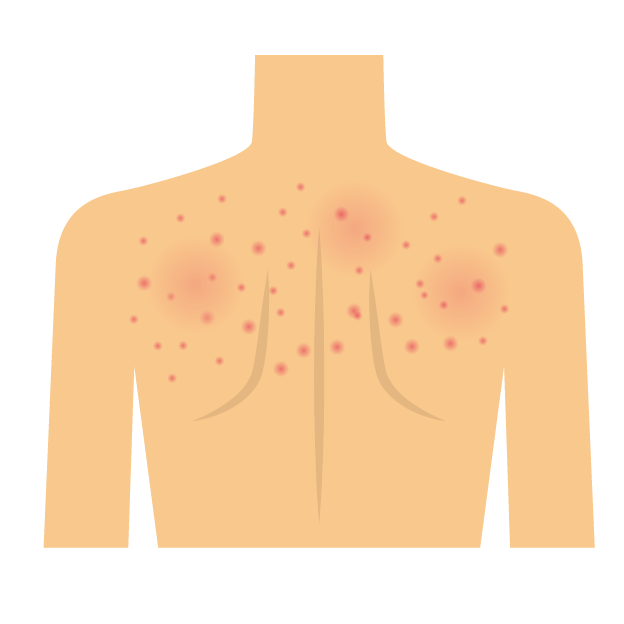 <a title=皮炎吃什么藥  href=http://m.358cha.cn/skin/cutitis/ >皮炎</a>濕疹